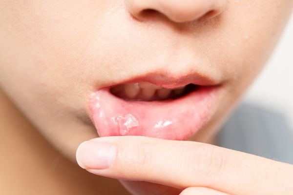 Aphte de la bouche : symptômes et causes