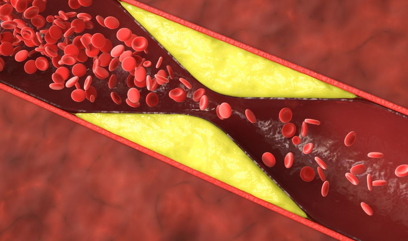 Anomalies du cholestérol et des triglycérides : causes et conséquences